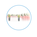 Ząb za ząb - era implantów