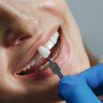 Bonding zębów – szybka i skuteczna metoda na piękny uśmiech